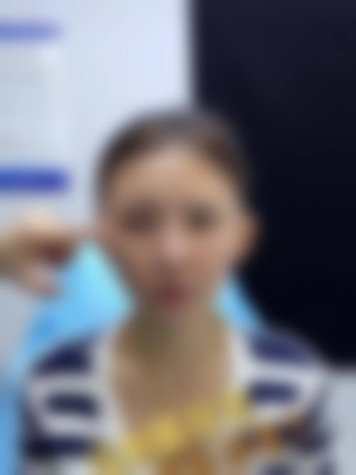 乔雅登雅致填充泪沟能维持多久？