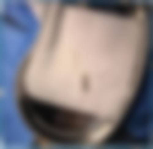 深圳透明医疗美容诊所皮下异物取出骨干医生于艳菊主事医师风采