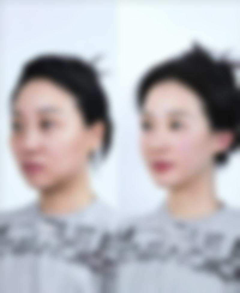 玻尿酸填充脸部有什么后遗症？