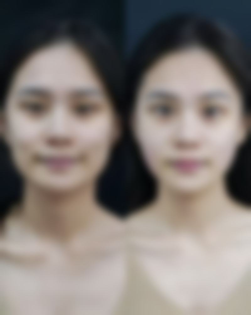 如何选择合适的医院和医生进行玻尿酸填充脸部？