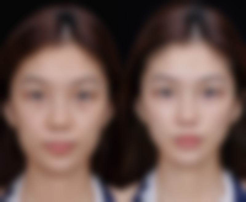 乔雅登雅致填充泪沟成效咋样？