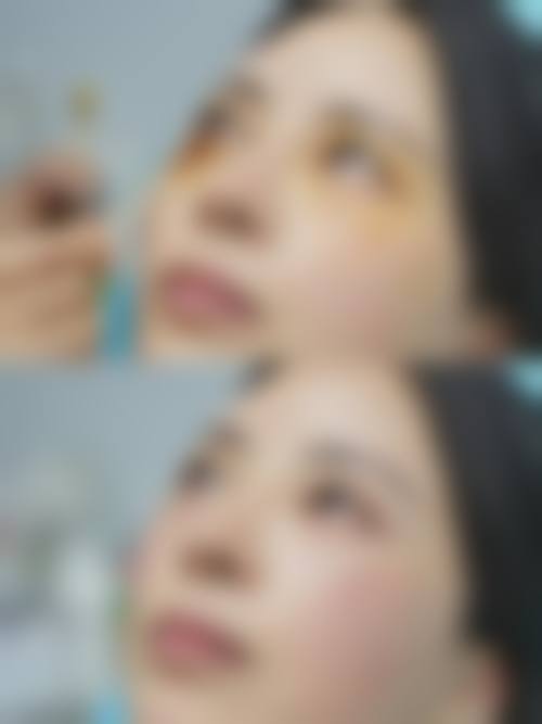 新月型双眼皮的常见认知偏差与误解