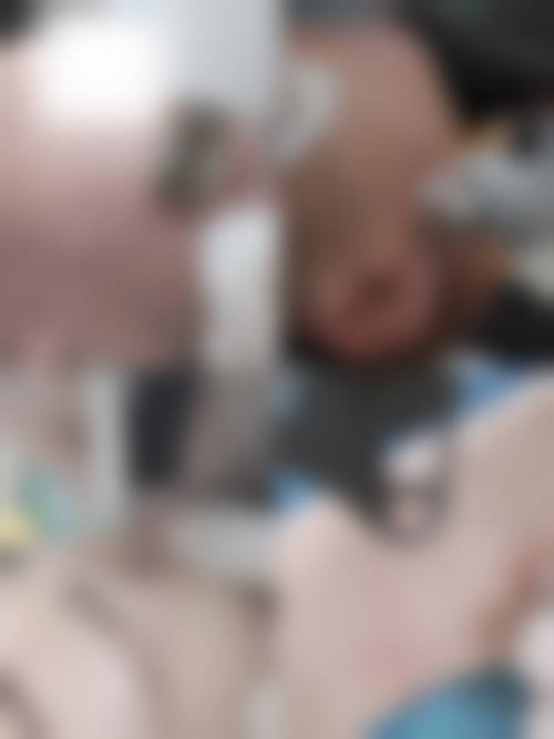 疤痕增生手术切除后还会增长吗