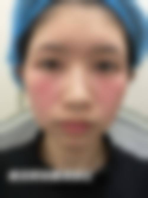 割双眼皮有什么后果吗？可能出现肿胀淤血、感染留疤，但护理好可降低风险！如果成效不理想，是否有补救与修复空间