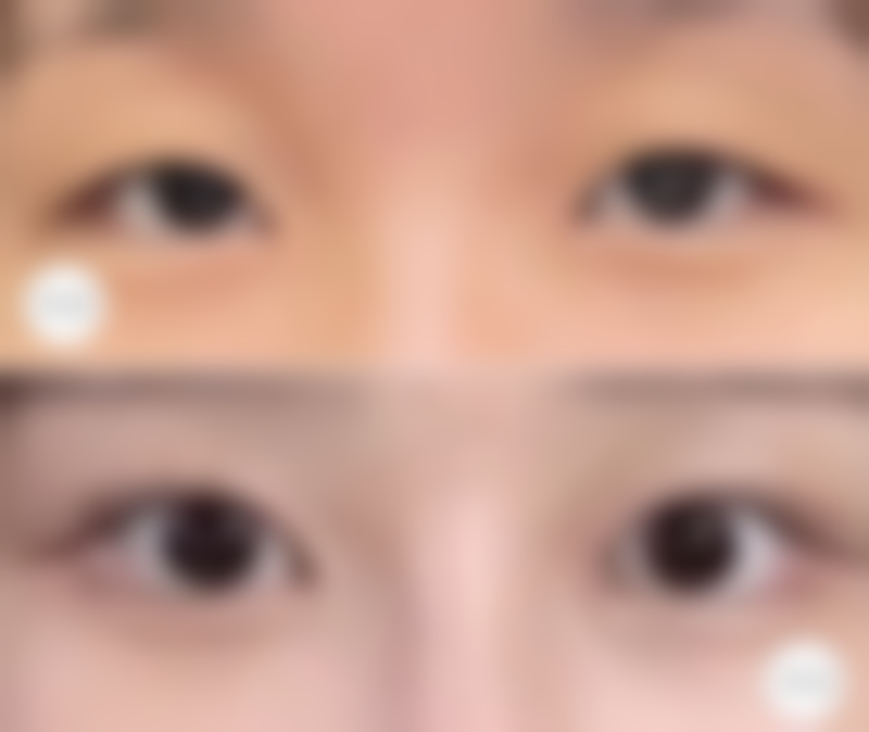 开扇型双眼皮是什么？通常在什么医学背景下被选择？