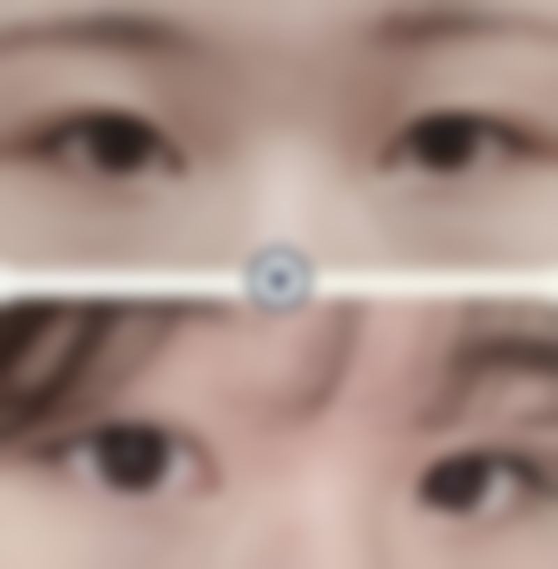 割双眼皮有什么后果吗？可能出现肿胀淤血、感染留疤，但护理好可降低风险！真实修复过程与不适时间线