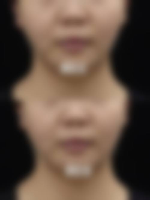 面部吸脂手术后多久能看到成效？