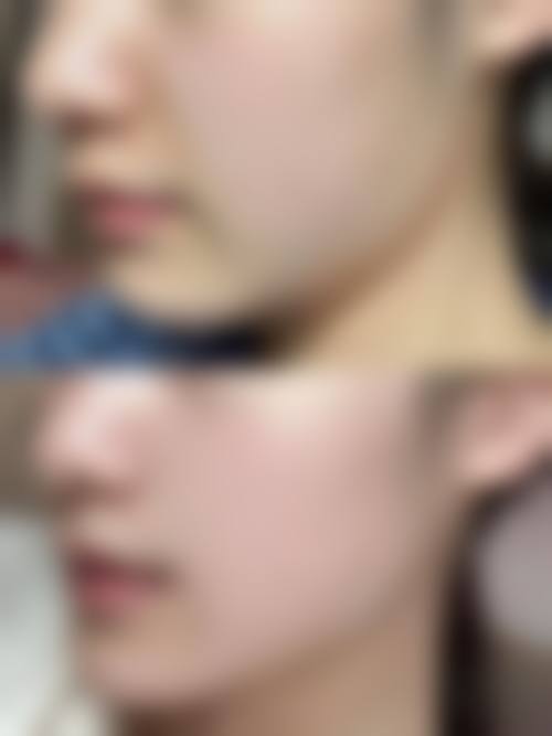 面部吸脂手术后遗症有哪些？如何应对？