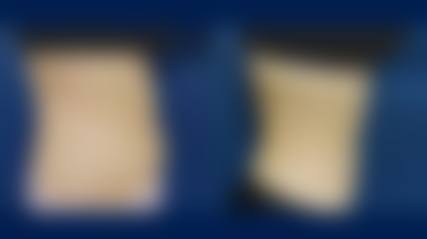 臀部吸脂本身能解决什么、不能解决什么？