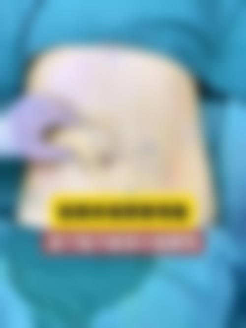 臀部吸脂是什么？通常在什么医学背景下被选择？