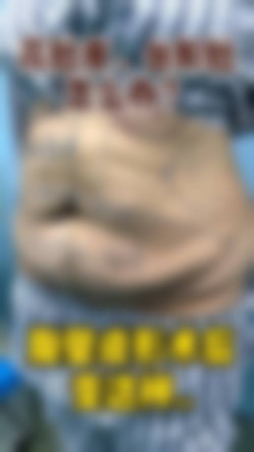 臀部吸脂术后是否需留院护理的常见认知偏差与误解