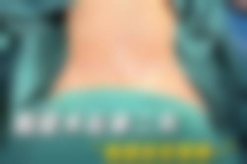 哪些情况下抽脂的成效更容易提前衰减