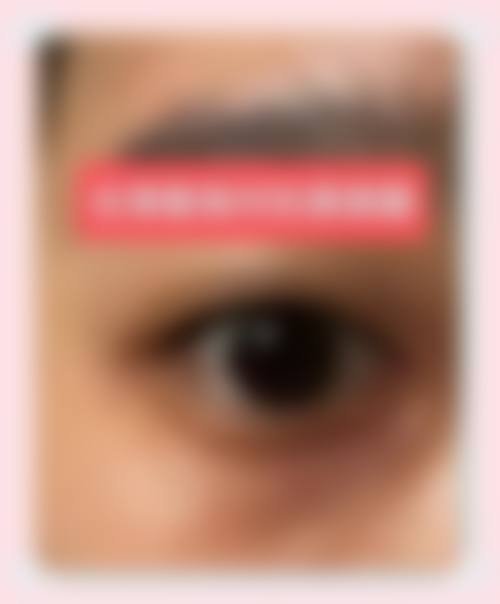 眼膜去眼袋的成效稳定性与哪些条件直接相关