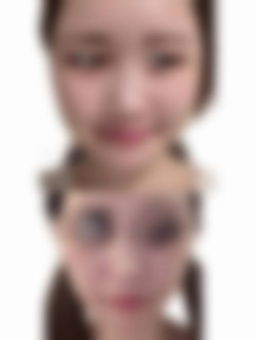 面部吸脂手术有哪些风险？可控与不可控需分清