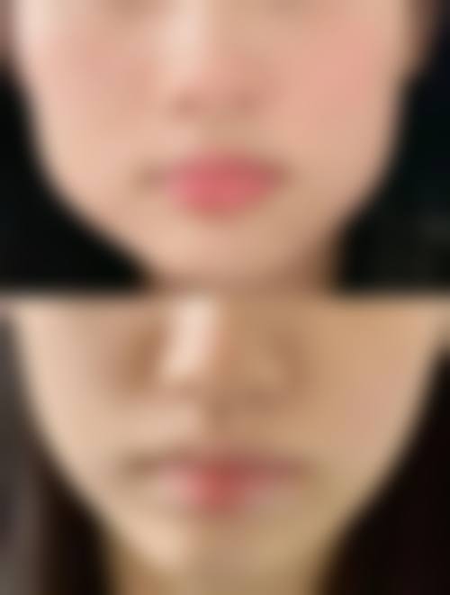 面部吸脂术后多久消肿？1 - 2 周逐渐消退