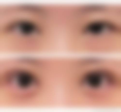 如何为眼膜去眼袋设定一个合理且可验证的成效目标