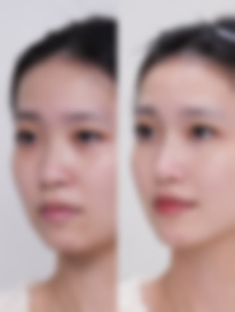 面部吸脂手术成效如何？即时与长期成效显现