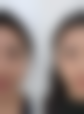 从医学角度看，激光去眼袋的风险主要集中在哪些环节？