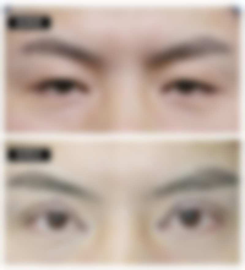 双眼皮手术价格区间及费用差异来源