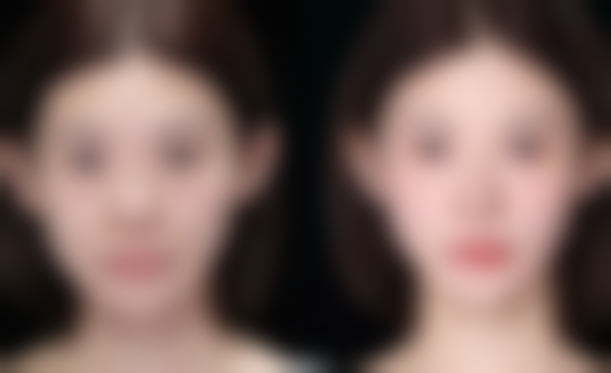 做双眼皮需要注意什么事项？术前选好医生、做好检查，术后护理防感染、忌刺激！附术前术后要点