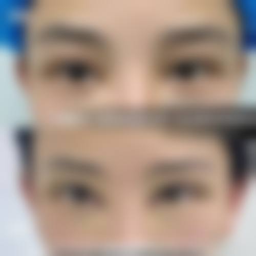 激光溶脂去眼袋多久完全修复