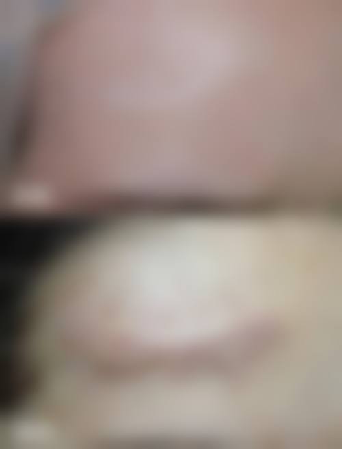 疤痕留下的黑色素多久能淡化？多数3 - 6个月可自愈，揭秘加速淡化超实用方法！ 