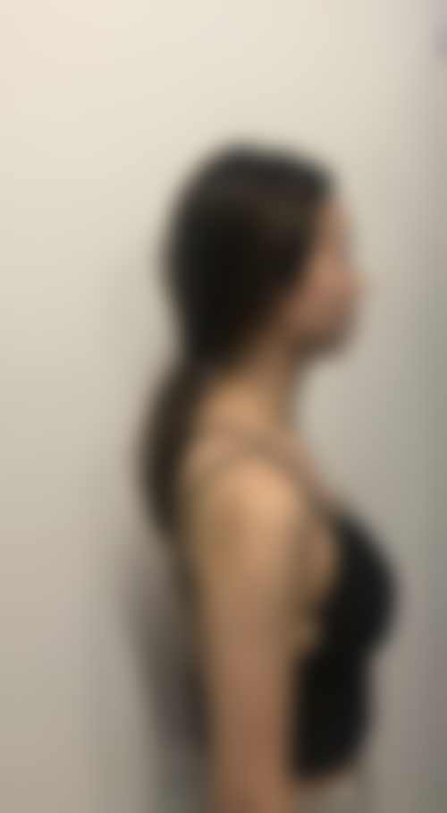 怎样保护好做过假体隆胸的胸部？