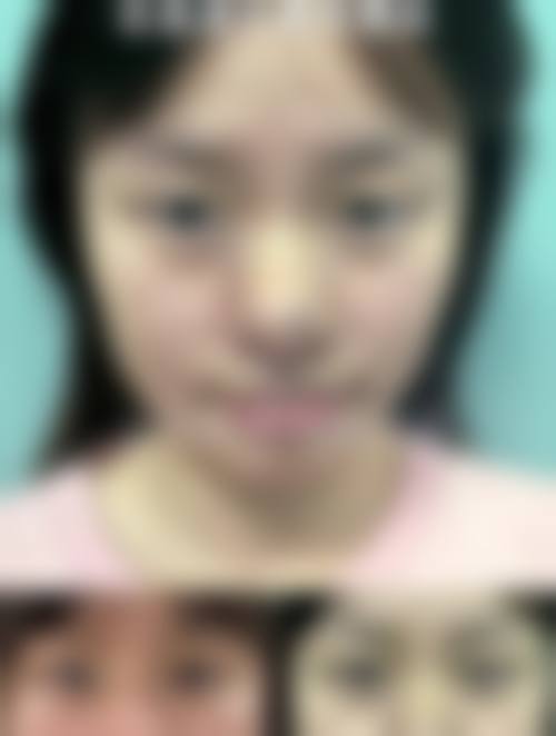 半肋骨隆鼻本身能解决什么、不能解决什么？