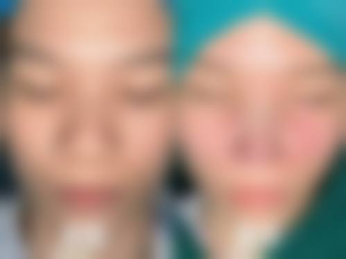 半肋骨隆鼻术后成效能维持多久及变化路径