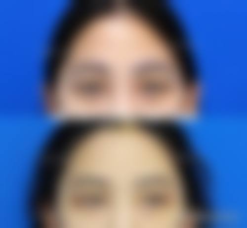 医生在埋线双眼皮长期成效判断中的作用