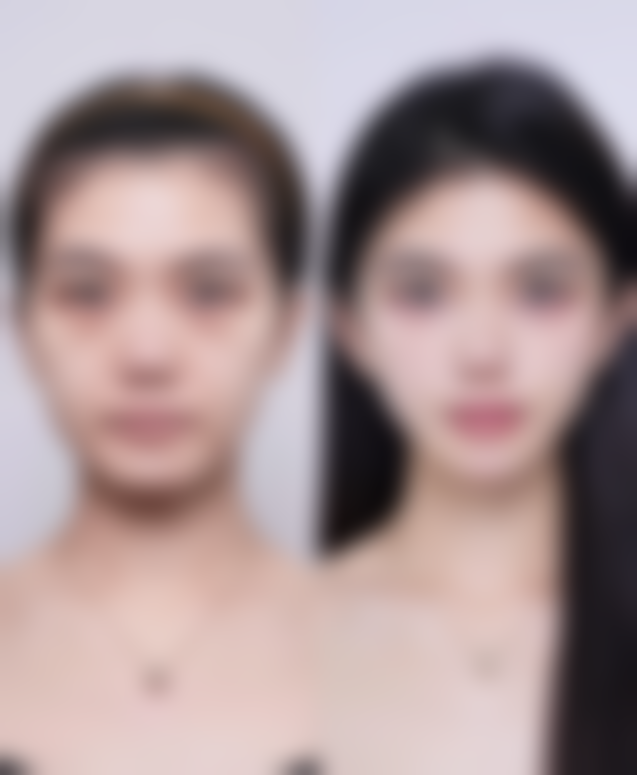 半肋骨隆鼻精细缝合的作用与成效