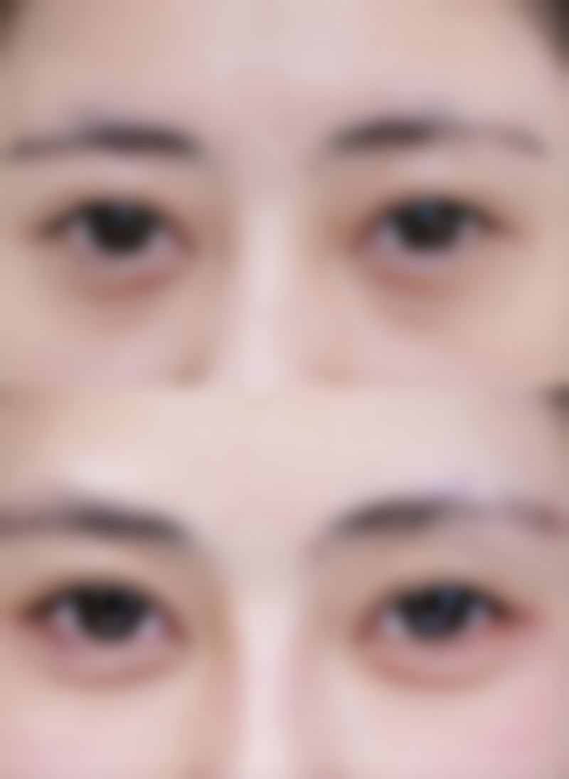 医生在判断割双眼皮成效边界中的作用