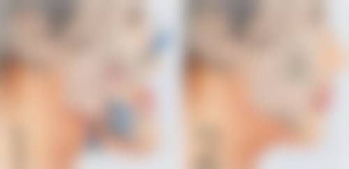 头发种植技术的成熟体现