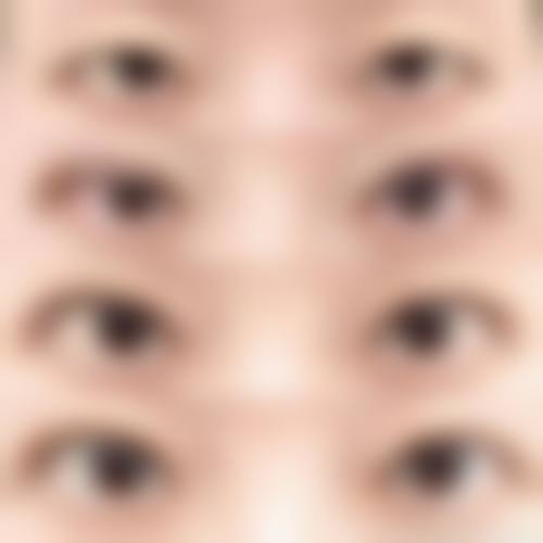 手术消除眼袋的修复过程及注意事项