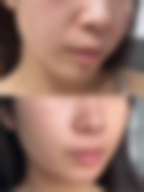 瘦脸针与其他瘦脸方法的材料对比