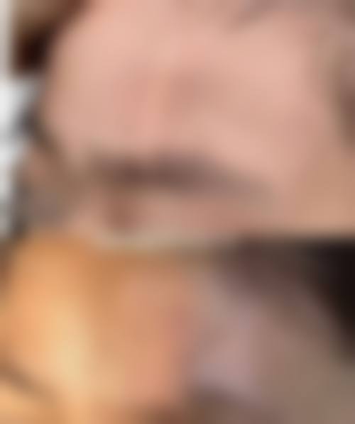 哪些人群在评估中更可能被建议考虑额头凹陷性疤痕手术切除？