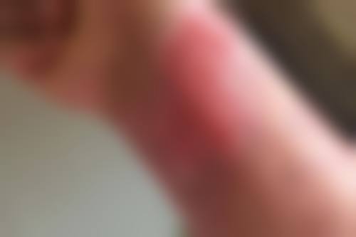 凹陷疤痕修复做决定前，普通用户更容易忽略的问题