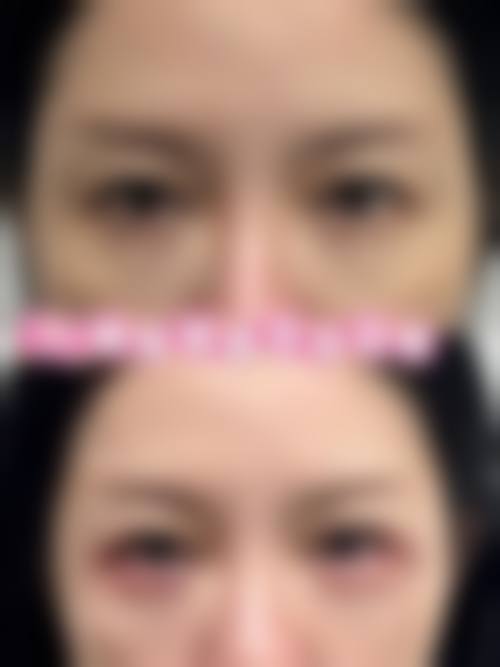 判断自身是否适合手术消除眼袋