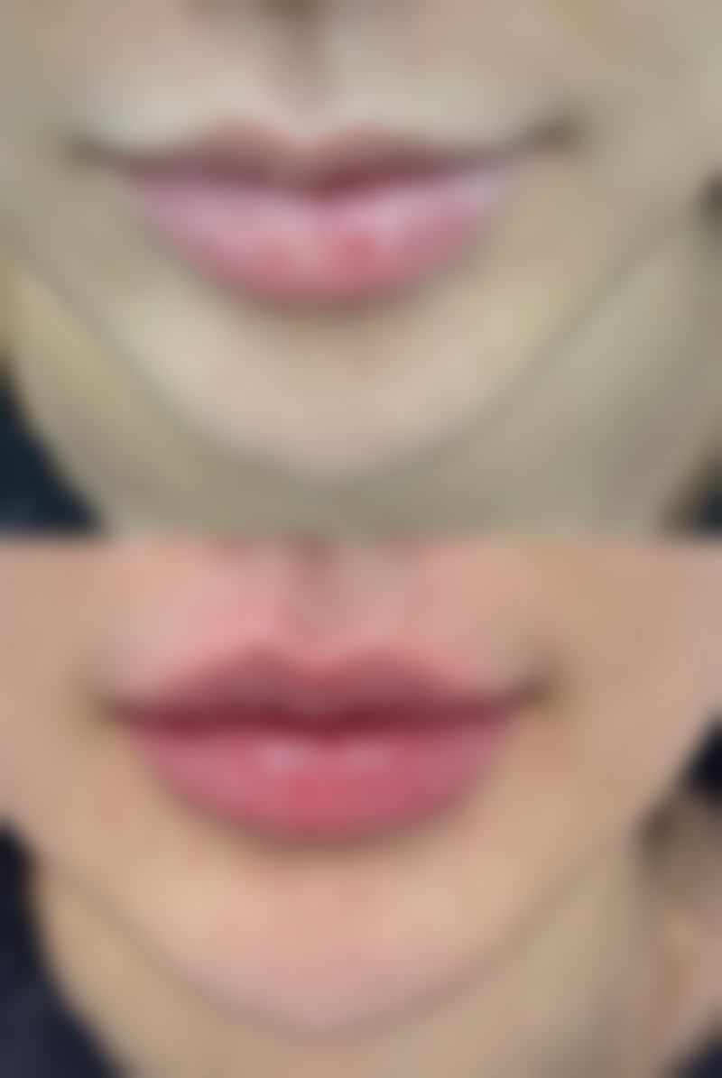 瘦脸针的作用原理及成效显现时间