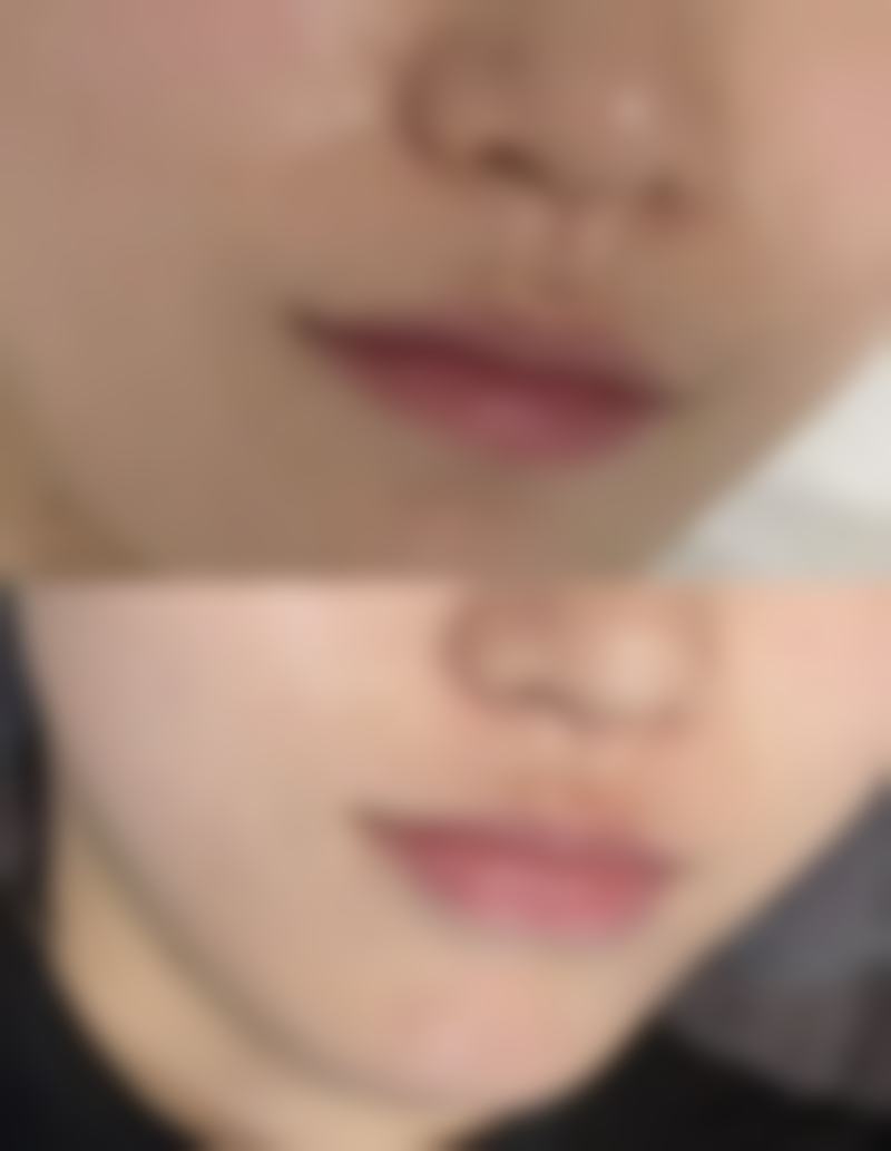 瘦脸针的优缺点分别是什么