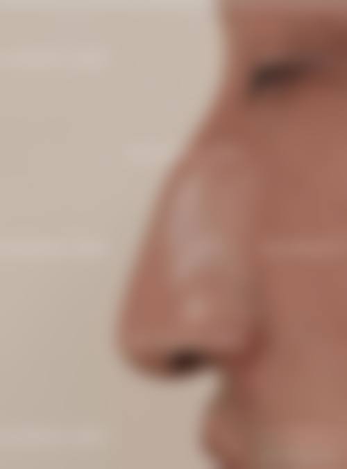 自体软骨隆鼻自然的原理是什么