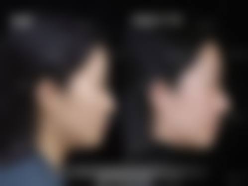 膨体隆鼻材料安心的依据是什么