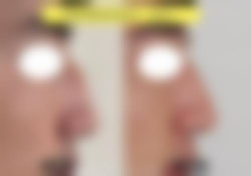 硅胶隆鼻哪些人群适合，哪些情况不建议选择？