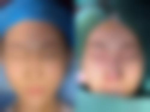 硅胶隆鼻常见并发症或后遗症，真实发生概率如何？