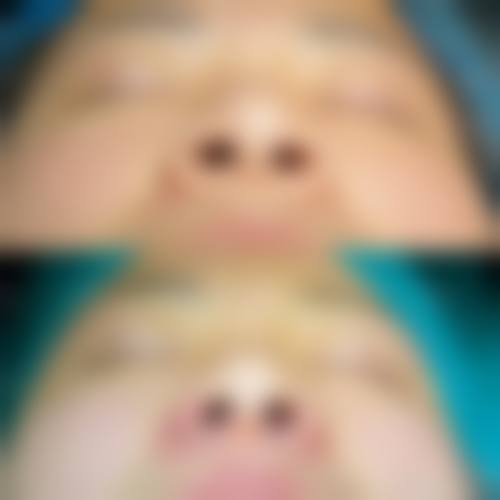 硅胶隆鼻技术或材料本身的优势与局限