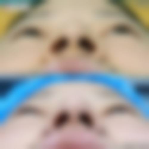 硅胶隆鼻是否危险？风险主要集中在哪些环节？