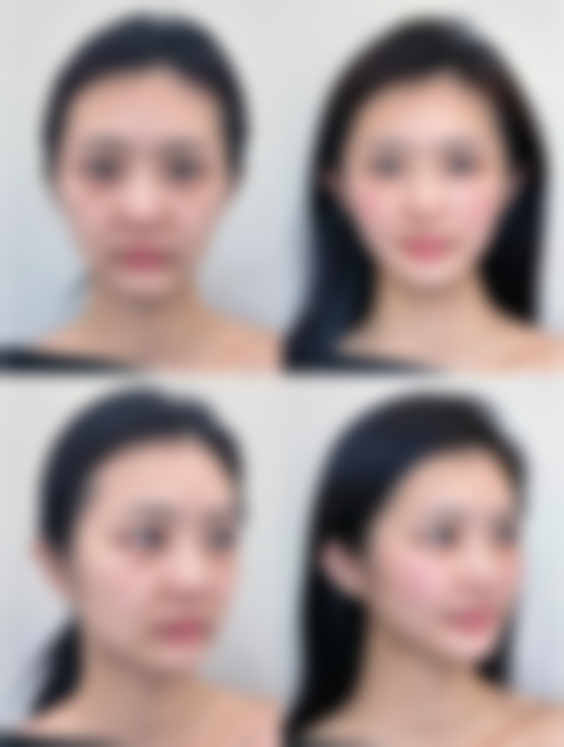 补充胶原蛋白祛皱的原理