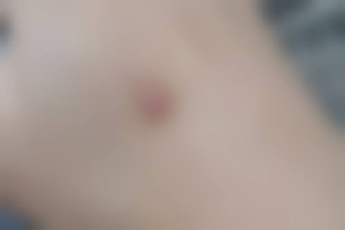 手术切除是什么？通常在什么医学背景下被选择？