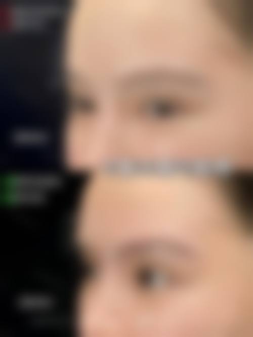 双眼皮哭肿后消肿妙招大揭秘