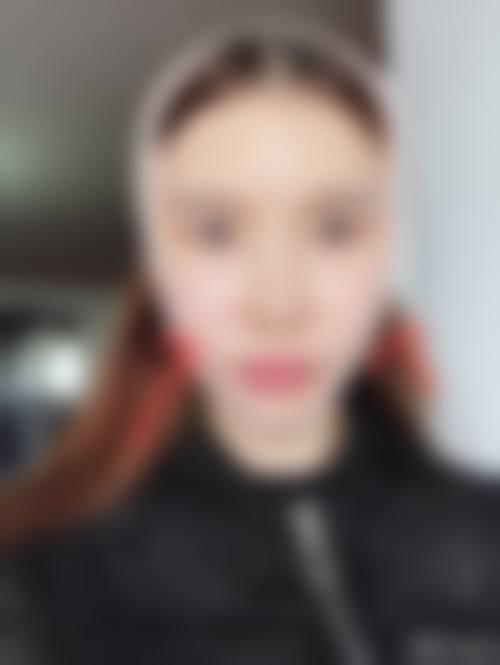 瘦脸针抗体后要停多久